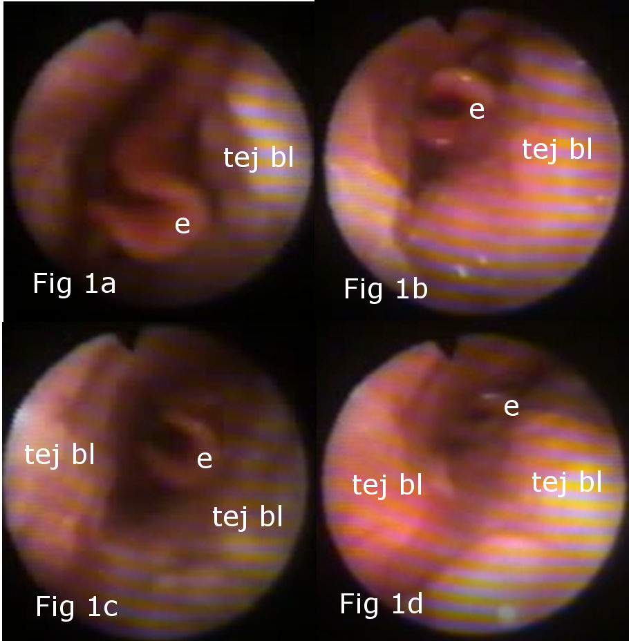 Colapso de los tejidos blandos sobre la epiglotis y la glotis durante el estridor. Collapse of the soft tissues over the epiglottis and the glottis during stridor..