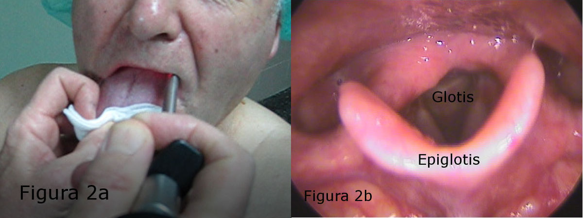 Imágenes de Laringoscopia Indirecta en un paciente normal. Images of Indirect Laryngoscopy in a normal patient.