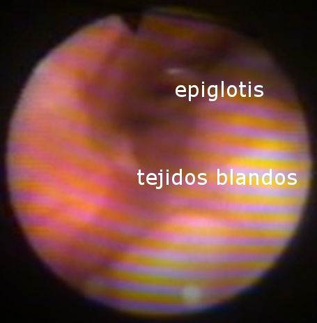 Imagen obtenida mediante fibroscopioa en un paciente roncador.