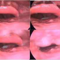 Study of the movements of the epiglottis.