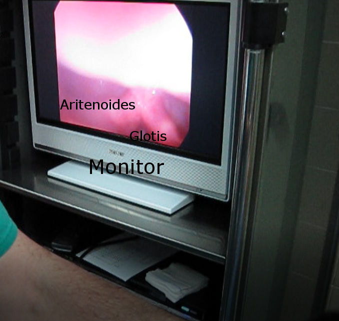 Imagen de Laringoscopia diagnóstica. Diagnostic laryngoscopy image.