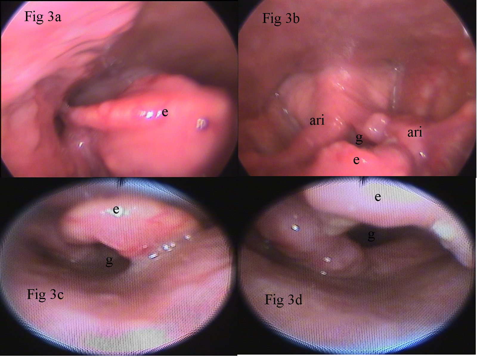 Laringoscopia Indirecta de tumor de epiglotis. Indirect laryngoscopy of epiglottis tumor.