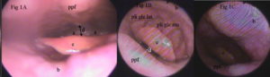 Laringoscopia diagnóstica de un paciente con hipertrofia de base de lengua y de epiglotis. Diagnostic laryngoscopy of a patient with tongue-based hypertrophy and epiglottis.