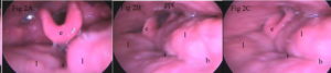 Laringoscopia diagnóstica de un paciente con epiglotis abarquillada y amígdala lingual hipertrófica. 