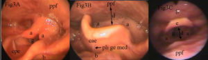 Laringoscopia diagnóstica de un paciente con vía aérea superior normal. Diagnostic laryngoscopy of a patient with normal upper airway.