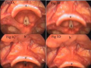 Movimiento de taponamiento de la glotis de una epiglotis normal. Clogging movement of the glottis of a normal epiglottis.