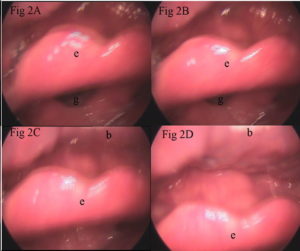 Movimiento para taponar el orificio de la glotis de la epiglotis en forma de hoja. Movement to plug the orifice of the glottis of the epiglottis in the form of a leaf.