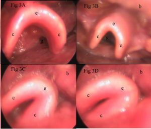 Movimiento de la epiglotis abarquillada para taponar el orificio de la glotis. Movement of the curled epiglottis to plug the orifice of the glottis.