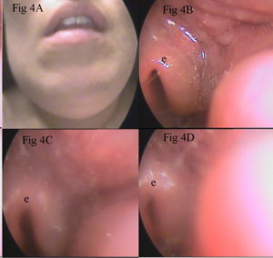 Movimiento de la epiglotis para cerrar la glotis, en una paciente afecta de un abceso cervical. Movement of the epiglottis to close the glottis, in a patient affected by a cervical abscess.