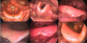 Epiglotis con forma normal, abarquillada y en forma de hoja. Epiglottis with normal shape, curled and leaf-shaped.