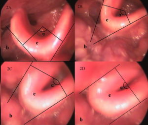 Movimiento de la epiglotis en forma abarquillada. Movement of the epiglottis in a curled shape.