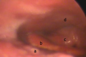 Laringoscopia indirecta de un paciente roncador. Indirect laryngoscopy of a snoring patient.