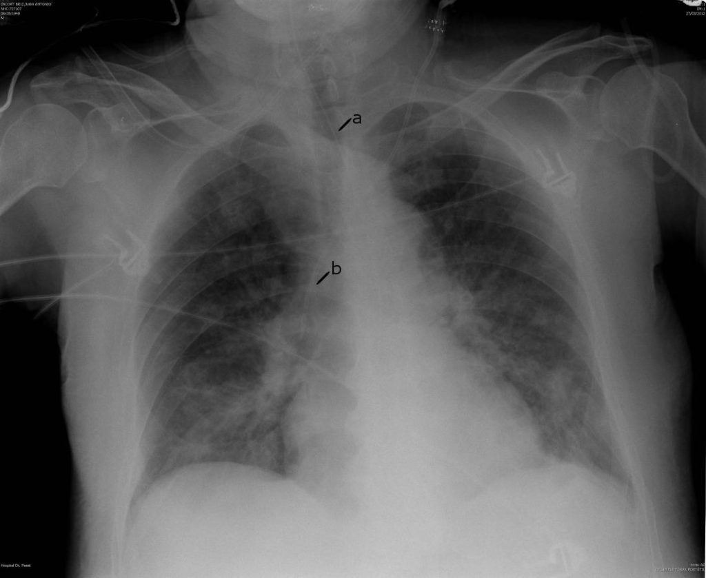 Rx de toráx del primer paciente con aspiración pulmonar. Rx of the first patient's chest with pulmonary aspiration.