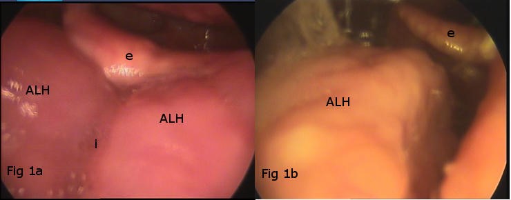 Imágenes de dos casos de ALH. Images of two cases of HLA.