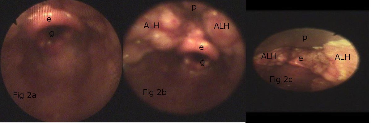 Primera parte de la maniobra de exploración, para diagnosticar la ALH. First part of the exploration maneuver, to diagnose HLA.