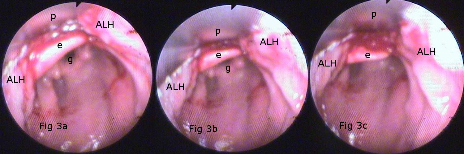 Sangrado durante maniobra de exploración mediante LD. Bleeding during exploration maneuver using LD.